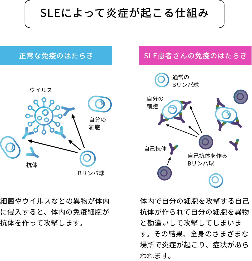 SLEによって炎症が起こる仕組み